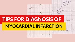 Tips for diagnosis of myocardial infarction ECGEKG interpretation [upl. by Robinet]