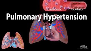 Pulmonary Hypertension Animation [upl. by Airamas]