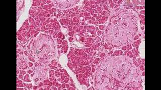 Histopathology Pancreas Type 2 Diabetes mellitus [upl. by Kile749]