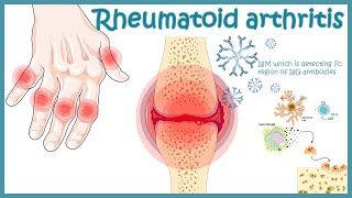 Rheumatoid Arthritis  autoimmune disorder  Pathophysiology risk factors treatment [upl. by Aisiram]