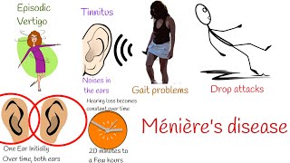 Vertigo and noise in the Ears Menieres disease Ménières disease [upl. by Armmat]