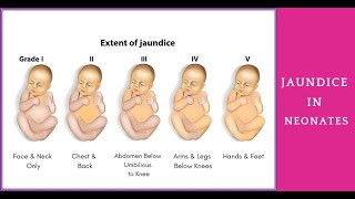 Jaundice Symptoms Types Causes amp Treatment amplemedicallectures [upl. by Tanberg]