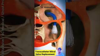 Transcatheter Mitral Valve Replacement TMVR shorts medical 3danimation [upl. by Sophia]