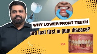 Why are lower front teeth lost first in gum diseases  DrPrem Alex Lawrence in tamil [upl. by Yrrag]