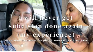 SUBCISION FOR PITTED ACNE SCARS MY EXPERIENCE I WILL NEVER DO IT AGAIN icepickrolling amp box scars [upl. by Senoj122]