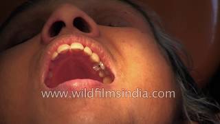 Root Canal treatment in India [upl. by Marillin]