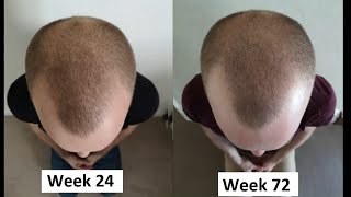 Scalp Massage For Hair Loss 48 Weeks  Top Hair Loss Treatments [upl. by Anytsyrk]