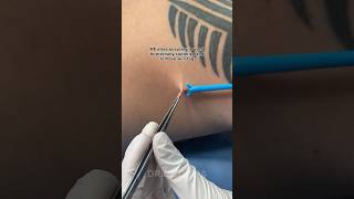 Skin Tag Removal in under 10 MINUTES  Dr Medispa [upl. by Ablasor]