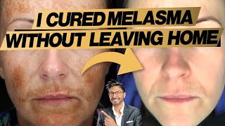 Melasma Treatment At Home Expert Doctors 3 Easy Steps  before and after [upl. by Gayla801]