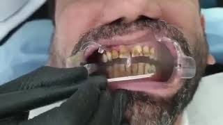 Teeth stain removal with Airflow [upl. by Spear]