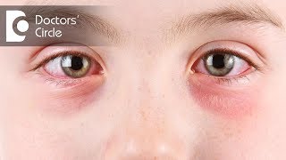 Symptoms of eye allergies  Dr Sriram Ramalingam [upl. by Aielam601]