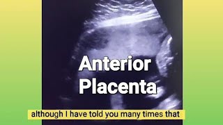 Anterior placenta baby gender  12 weeks Twin pregnancy  3 vessel cord or turtle sign  ultrasound [upl. by Reid]