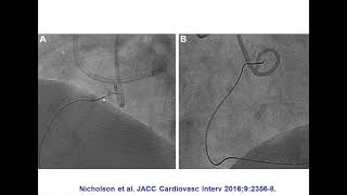 Emmanouil Brilakis  CTO Percutaneous Coronary Intervention Update 2017  2062017 [upl. by Michelina]