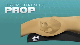 Stable Positioning for Iliosacral Screw Placement PROP [upl. by Honeyman]