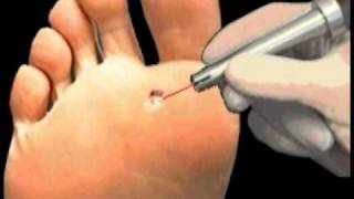 Plantar Wart Laser Treatment  Institute Beaute New York [upl. by Dimphia]