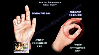 Anterior Interosseous Nerve Injury  Everything You Need To Know  Dr Nabil Ebraheim [upl. by Losse]