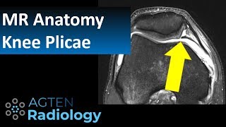 MRI Anatomy of Knee Plicae [upl. by Locklin]