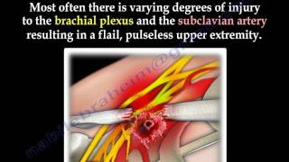 Scapulothoracic Dissociation  Everything You Need To Know  Dr Nabil Ebraheim [upl. by Good]