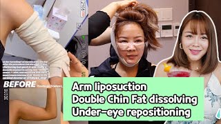 Yina Gohs PLASTIC SURGERY IN KOREA  Arm Liposuction Double Chin Laser and Eye Bag Removal [upl. by Ernaline]