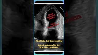 Takotsubo Cardiomyopathy Echo REBELEM FOAMus MedEd TakotsuboCardioMyopathy [upl. by Ruyle]