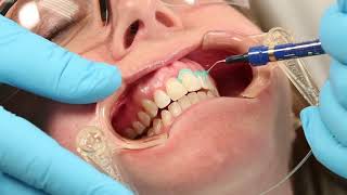 How To Use Ultradent Opalustre For Fluorosis Treatment [upl. by Ateinotna]