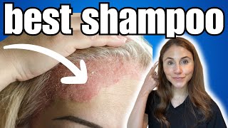 BEST Shampoo For Psoriasis  Dermatologist Recommended [upl. by Rimola]