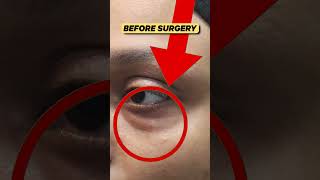 Eye Bags Removal  Blepharoplasty  Under Eye Fat [upl. by Terag]