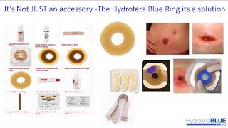 Ostomy Care with Hydrofera Blue Ostomy Ring [upl. by Lucienne]