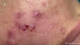 Big Cystic Acne Blackheads Extraction Blackheads amp Milia Whiteheads Removal Pimple Popping [upl. by Muiram]