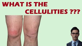 Understanding Cellulitis Causes Symptoms and Treatment  Comprehensive Guide 2023 [upl. by Znieh]