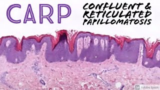 CARP Confluent and Reticulated Papillomatosis 5Minute Pathology Pearls [upl. by Pelmas]