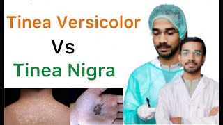 Tinea Versicolor Vs Tinea Nigra [upl. by Ebbie]