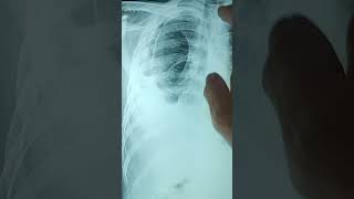 Small Pneumothorax ec TB paru  Pleural Effusion  DILI  Denisoeroso [upl. by Domella]