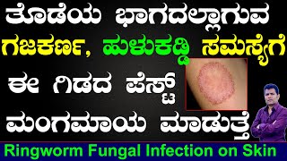 Ringworm Fungal Infection on Skin  Gajakarna Mane Maddu in Kannada  Fungal Infection  Dr Praveen [upl. by Lesig252]