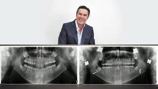 Carrière Motion treatment protocol for class III malocclusions [upl. by Giltzow]