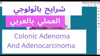 Colon histology  colonic adenocarcinoma  Tubulovillous adenoma low grade and high grade [upl. by Dnomsed]