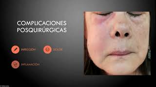 Alveolitis Complicación más frecuente en la tercera molar [upl. by Lletnom]