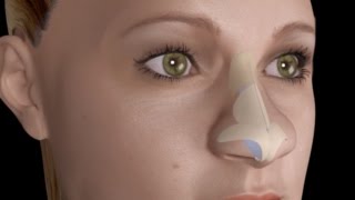 Bulbous Large Nasal Tip Nose Job Rhinoplasty [upl. by Rodrique]