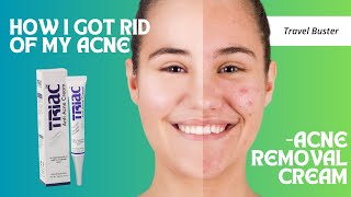 Triac Anti acne cream Review  Went from Acne Prone skin to Clear Skin  Honest Review [upl. by Atteynek]