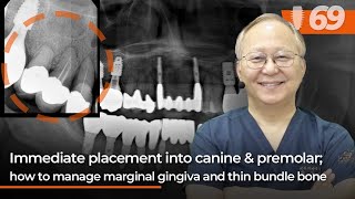 Immediate placement into canine amp premolar how to manage marginal gingiva and thin bundle bone [upl. by Levona878]