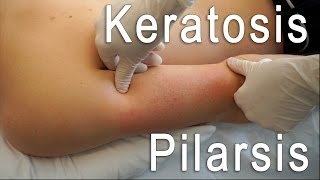 Keratosis Pilaris Clear  Brilliant Treatment FT Eric Smith  BLUSH Beverly Hills [upl. by Leventis]