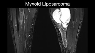 Myxoid Liposarcoma [upl. by Editha784]