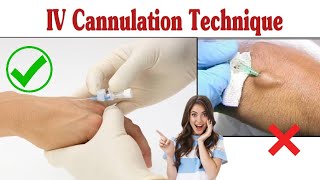 Intravenous Cannulation Technique  IV Cannula Procedure [upl. by Kosak]