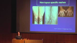 Lupus The Skin amp Hair  Dr Abby Macbeth East Anglia Lupus Info Day Oct 2013 [upl. by Vaules]