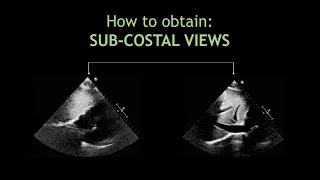 How to obtain SUBCOSTAL VIEWS Echocardiography [upl. by Stockton202]