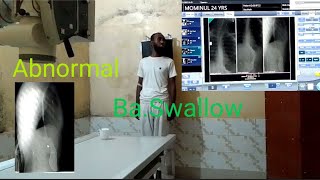 Abnormal Barium Swallow  Radiography [upl. by Jacobo]