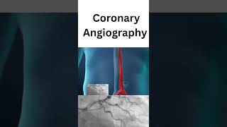 Coronary angiography  treatment of coronary heart disease [upl. by Ogires]