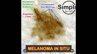 Melanoma in situ Dermoscopy Explanation [upl. by Ohare621]