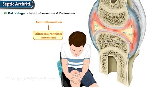 Septic Arthritis Orthopedics Lecture [upl. by Eisaj552]