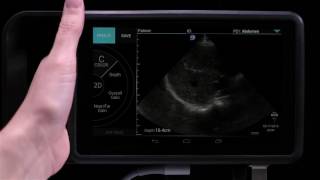 Sonosite iViz 7 Annotating an Image [upl. by Esinrahs]